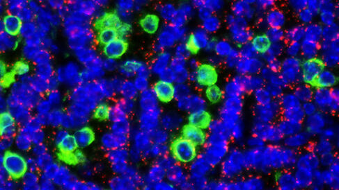 Lung tumour cells expressing switchable Myc, surrounded by macrophages
