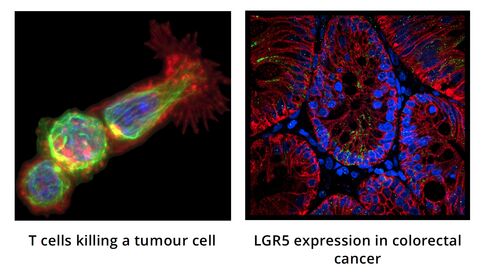 T cells killing a tumour cell & LGR5 expression in colorectal cancer