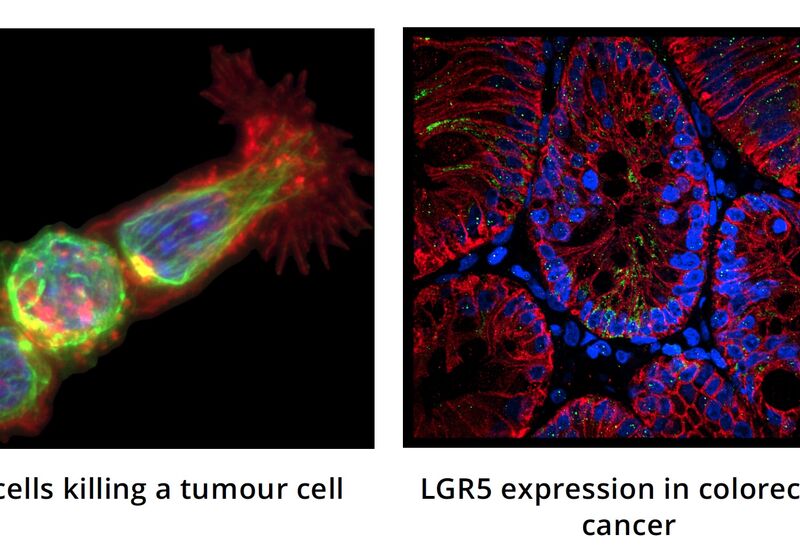 T cells killing a tumour cell & LGR5 expression in colorectal cancer
