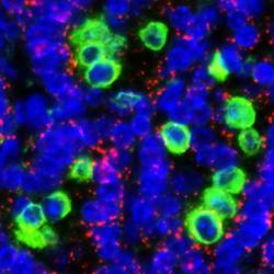 Lung tumour cells expressing switchable Myc, surrounded by macrophages
