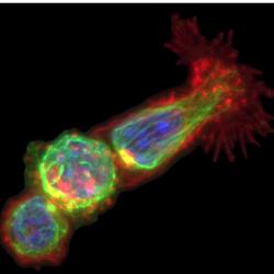 T cells killing a tumour cell & LGR5 expression in colorectal cancer