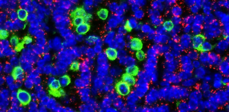 Lung tumour cells expressing switchable Myc, surrounded by macrophages Lung tumour cells expressing switchable Myc, surrounded by macrophages