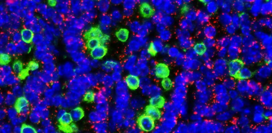 Lung tumour cells expressing switchable Myc, surrounded by macrophages