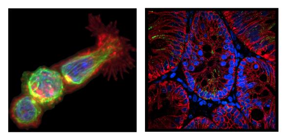 T cells killing a tumour cell & LGR5 expression in colorectal cancer T cells killing a tumour cell & LGR5 expression in colorectal cancer